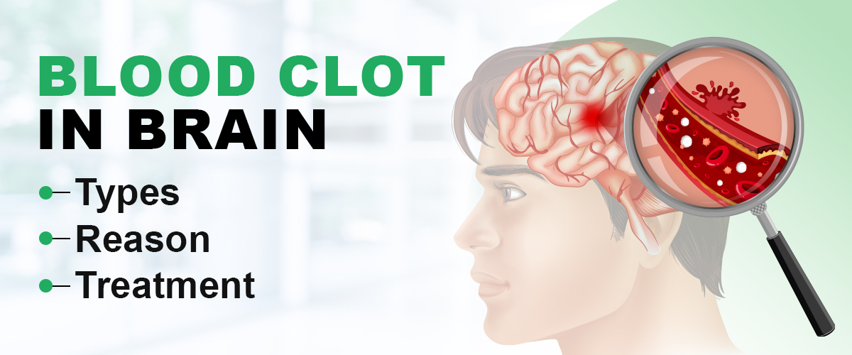 Blood Clot in Brain: Symptoms,Types, Reason & Treatment