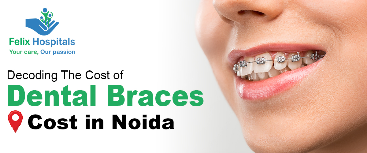 Dental Braces Cost in Noida