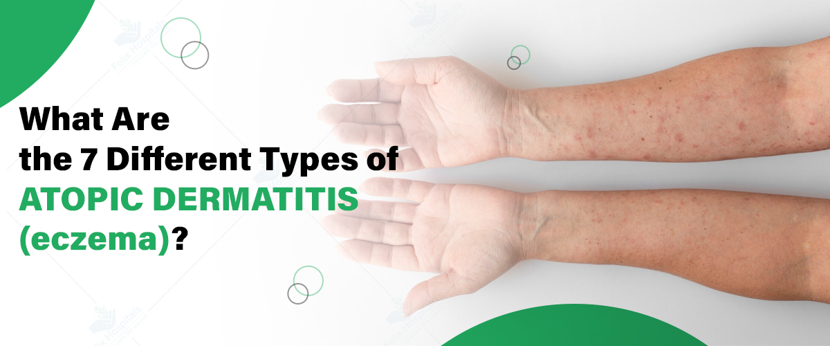 Best Hospital for Eczema (Atopic Dermatitis) Treatment