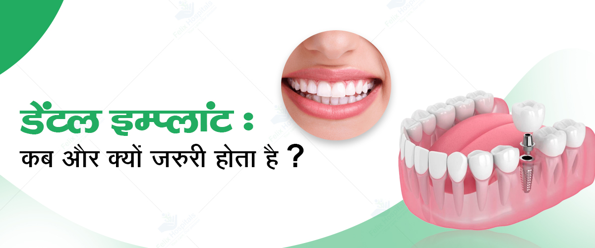 dental implant